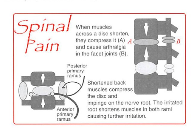 Intramuscular stimulation needles inserted into back muscles for neuropathic pain treatment